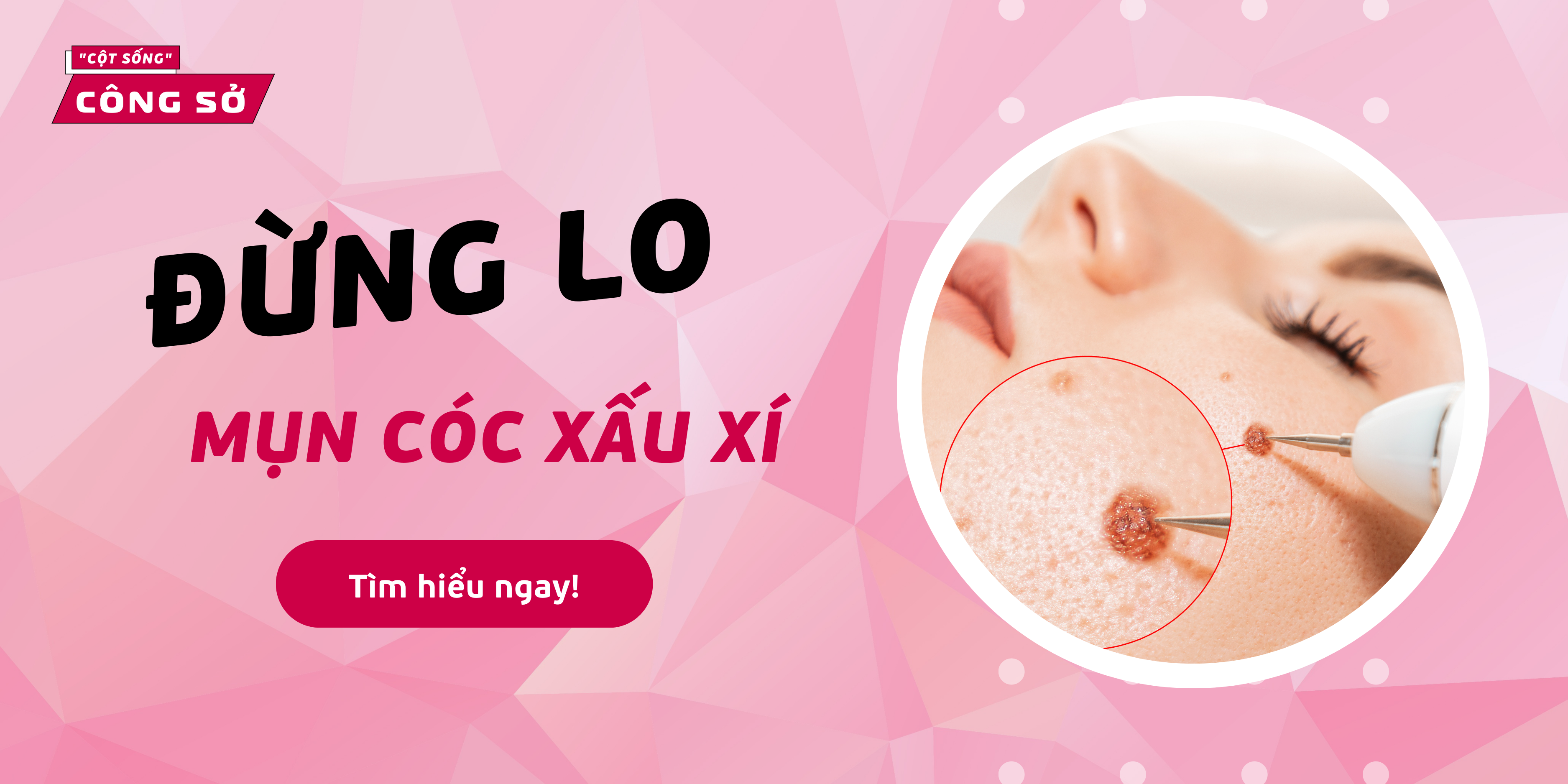 Đừng lo mụn cóc xấu xí
